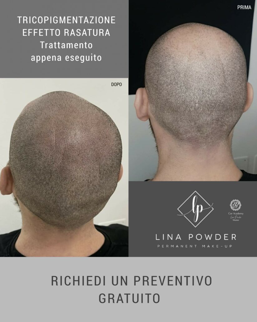 TRICOPIGMENTAZIONE soluzione innovativa ed efficace contro le calvizie e il diradamento dei capelli, sia per uomini che per donne.
Una tecnica non invasiva che, attraverso la pigmentazione del cuoio capelluto, crea un effetto ottico naturale simile ai capelli rasati o infoltiti.
Ideale per coprire cicatrici, alopecia o migliorare l'aspetto di chi soffre la perdita di capelli.